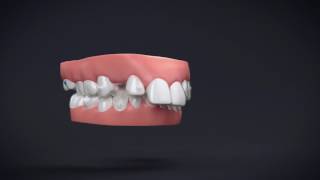 Invisalign Teen by CCC Smiles Orthodontist Sydney  - straight teeth for teens without braces