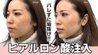 ヒアルロン酸 Youtube ヒアルロン酸 Youtube