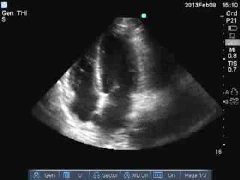 Echo Apical 4 chamber view- Normal