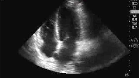 Echo Apical 4 chamber view- Normal