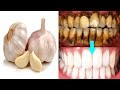 How to whiten teeth naturally at home with Garlic and Lemon