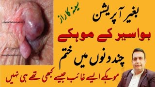 بغیر آپریشن بواسیر کے موہکے (مسے) ختم piles treatment نسخہ میں مٹی کاتیل ھےروغن  تارپین نہیں ھے