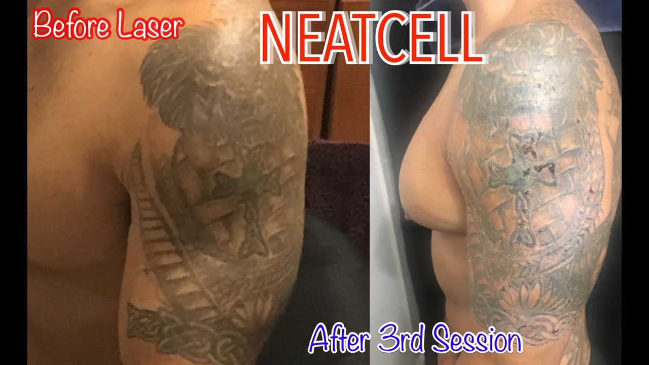 Tattoo removal clinics Tijuana TOP 10