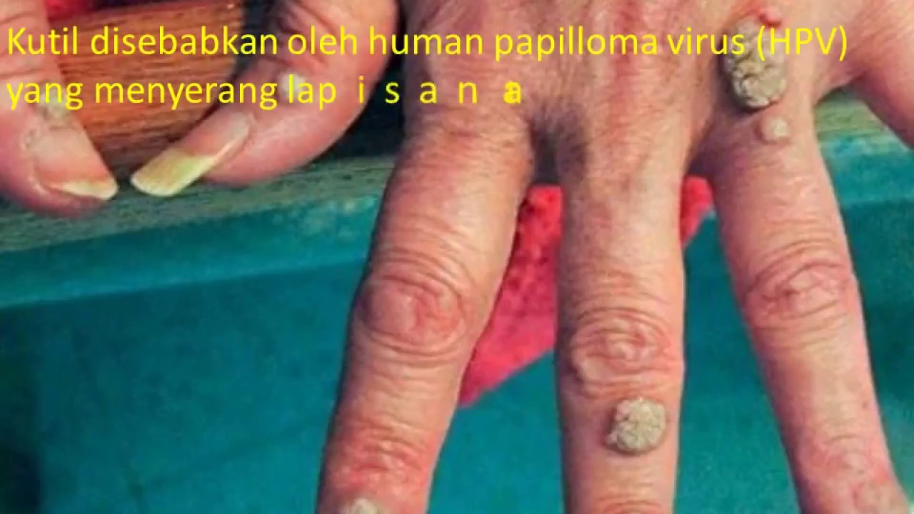 CARA MENGHILANGKAN KUTIL DI TANGAN 