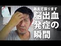 【発症直後の音声あり】脳出血発症の瞬間を当事者が振り返る