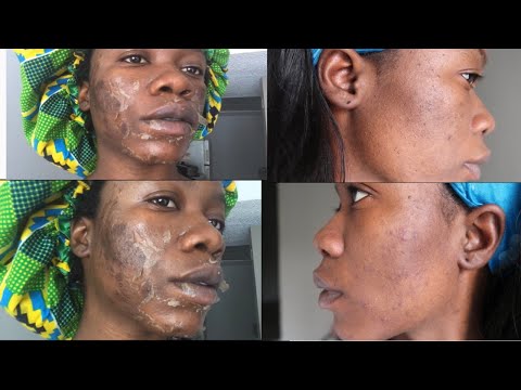 My At Home Chemical Peel Experience. #ChemicalPeel #TCA Peel | I Freak Out!?