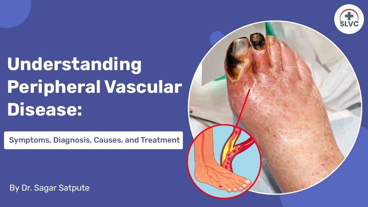 Understanding Peripheral Vascular Disease Symptoms Causes And Understanding Peripheral Vascular Disease Symptoms Causes And