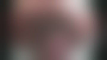 14 193GS Laparoendoscopic Transgastric Resection of GIST at GE Junction