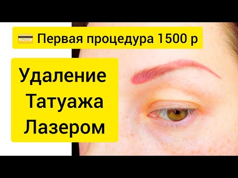Как снять татуаж в домашних условиях УДАЛЕНИЕ ТАТУАЖА: сколько процедур потребуется. - ejfe.ru