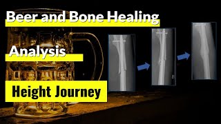 Beer and Bone Healing for Limb Lengthening or Leg Lengthening Surgery Patients