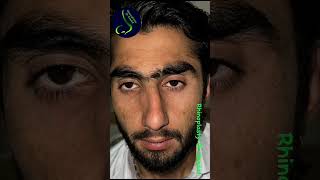 Thick-skin rhinoplasty. Before &amp; after #NoseReshaping #CrookedNose #DrSaadatUllah #NoseJobPakistan
