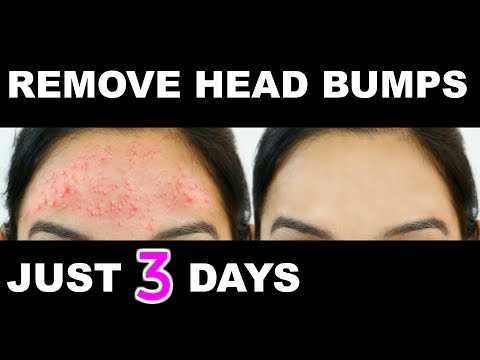 how-to-get-rid-of-small-pimples,-head-bumps-fast-naturally-|-anaysa