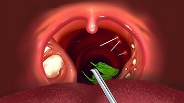 nếu xương cá mắc vào cổ họng bạn sẽ làm gì. một trải nghiệm hoạt hình của cô gái khi bị hóc xương cá