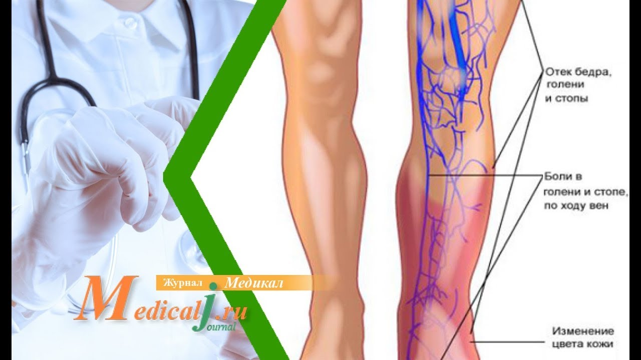 Тромбоз бедренных вен