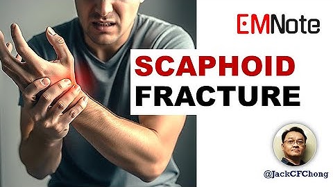 Scaphoid Fracture: The Hidden Wrist Injury You Can