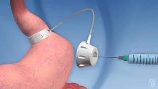 Laparoscopic adjustable gastric banding