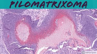 Pilomatrixoma...with lots of blue basaloid cells (and mitoses!) screenshot 2