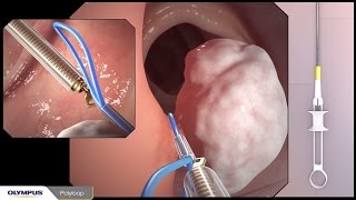 Colonoscopy with polypectomy procedure overview using Olympus devices