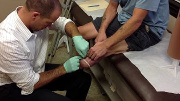 The Casting Procedure | limb-loss.org