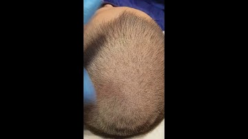 Creating Density Healed 1st session SMP Hair Loss Scalp Micropigmentation by El Truchan