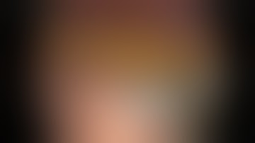 Intragastric GIST, Robotic resection