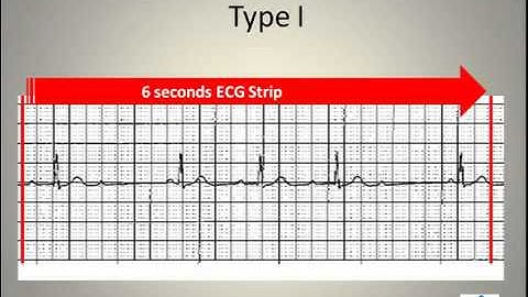 ECG Interpretation Video Lecture 6