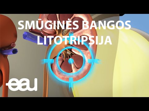 SMŪGINĖS BANGOS LITOTRIPSIJA  (SWL Lithuanian)