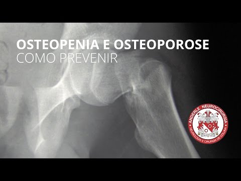 COMO PREVENIR Osteopenia e Osteoporose - MUITO BOM -  Dr Diogo Neurocirurgião