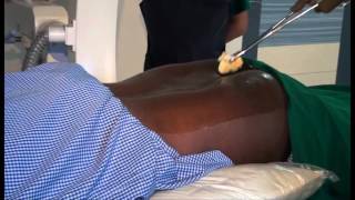 Caudal Epidural Injection Video - By Dr Vicky Nevagi Pain Clinic Of India Goa Branch