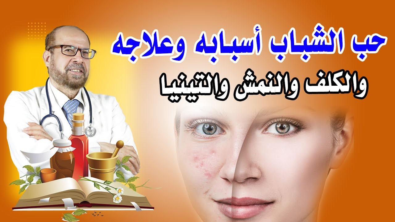 حب الشباب🍀 أسبابه 🍀وعلاجه 🍀والكلف 🍀والنمش🍀 والتينيا