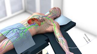 Using ICG with the 1588 AIM Platform and ENV Mode in Laparoscopic Cholecystectomy