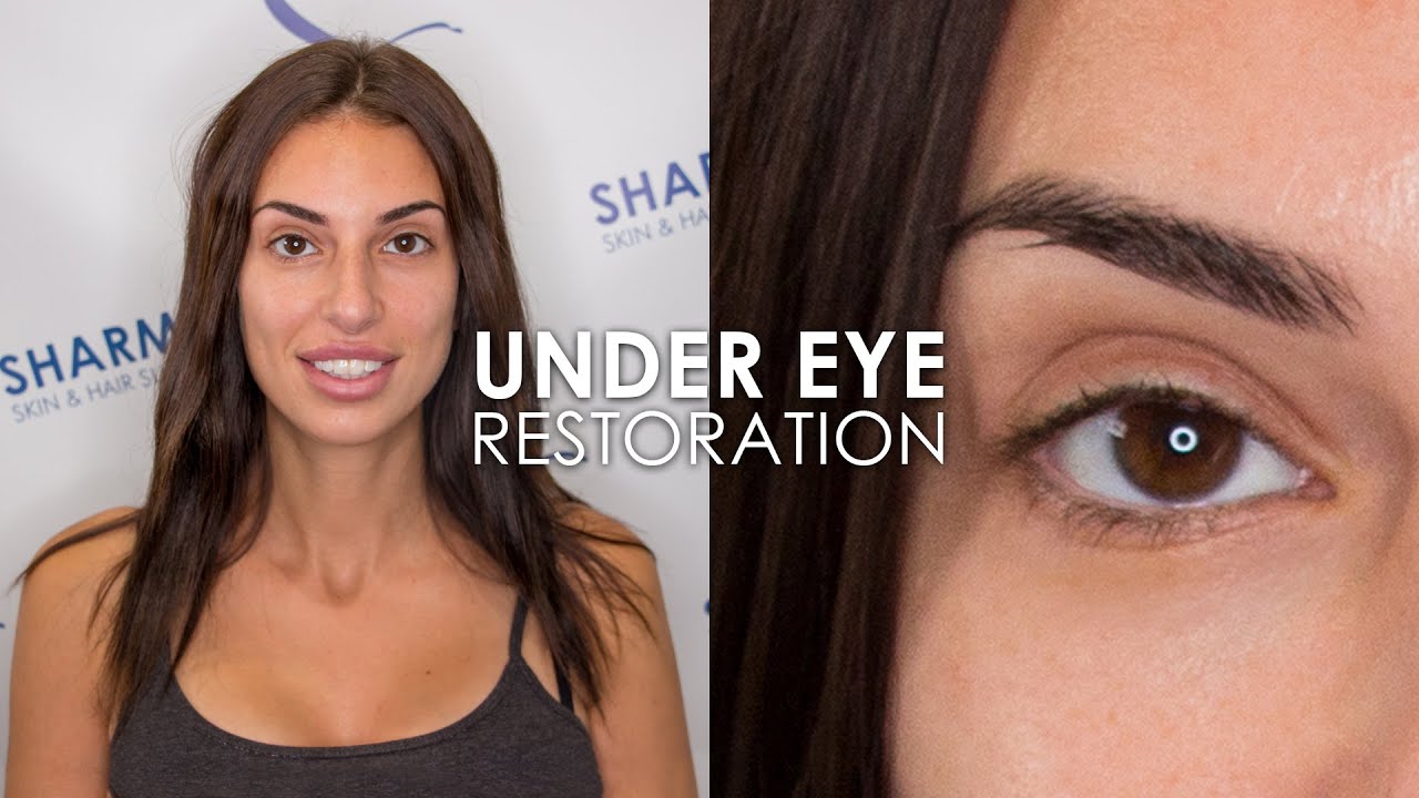 Under Eye Restoration with Filler