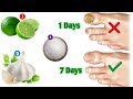 Nail Fungus Treatment|Use Raw Garlic Onion and Lemon|Ruzi Health Tips