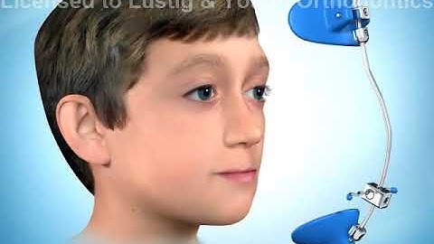 Orthodontic Reverse Pull Headgear Facemask | Lustig & Young Orthodontics | Invisalign & braces TX