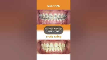 Hành trình LỘT XÁC nhờ niềng răng của Thu Hương