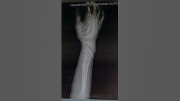 FRACTURE BOTH BONE FOREARM