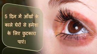 How To Remove Dark Circles At Home | 5 दिन में आँखों के काले घेरों से हमेशा के लिए छुटकारा पाएं |