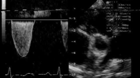severe  pulmonary stenosis:cw doppler recording