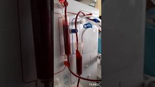 Previniendo hemólisis en circuito extracorporeo de hemodiálisis. #enfermeria #hemodialysis