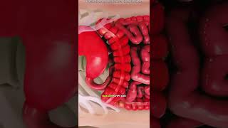 Colon polypectomy(3D animation)