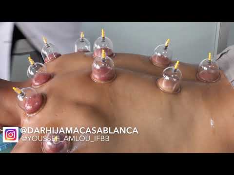 DAR HIJAMA CASABLANCA - HIJAMA - CUPPING THERAPY