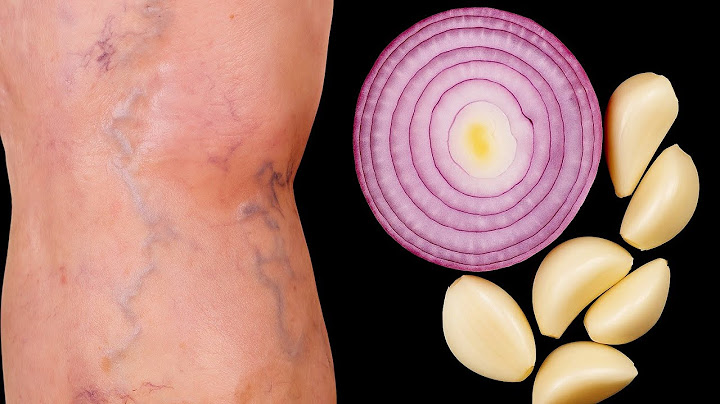 2 Natural Fixes That Erased My Varicose Veins! You Won’t Believe It!