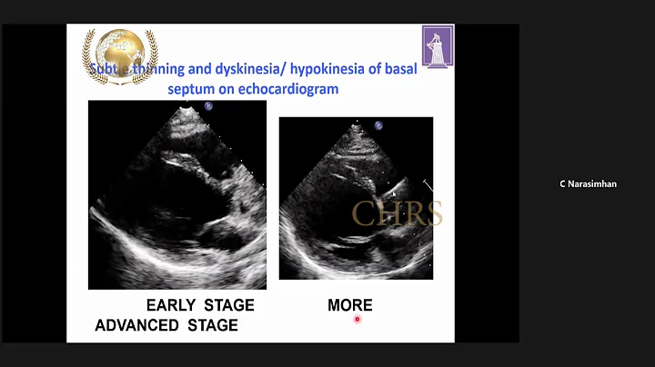 Premature Ventricular Contraction - Evolution and Management -Dr.Narasimhan-D...  EP UPDATE