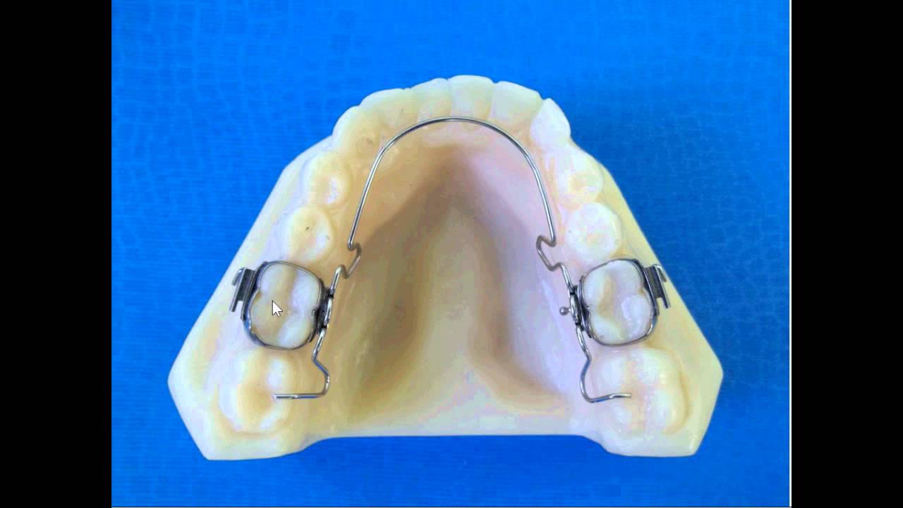 lower lingual holding arch