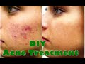 DIY Acne Treatment - It Works! How to Get Rid of Acne