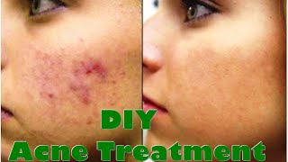 DIY Acne Treatment - It Works! How to Get Rid of Acne