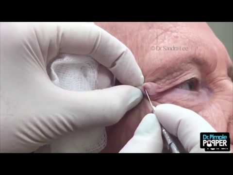 Top 10 Blackheads Removal Satisfying By Dr Sandra Lee 52
