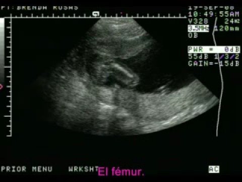 Ecografia De Bebe De 17 Semana Varon Imagui