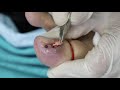 Ep_2055 Infected ingrown toenail removal 👣 ทะลุไหม?  😷 (This clip is from Thailand)