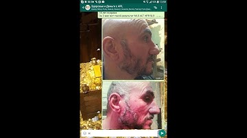 результат APL- псориаз